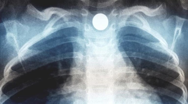 “Συναγερμός” για παιδί που κατάπιε μαγνητάκι ψυγείου