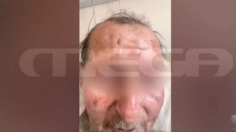 Τροχαίο στο Λαγκαδά: Προφυλακίστηκε ο 60χρονος που οδηγούσε μεθυσμένος και έπεσε πάνω στην 50χρονη Χαρά