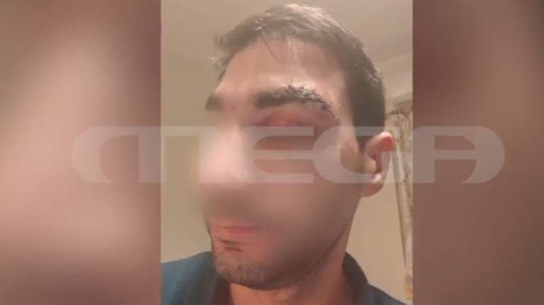 Αίγιο: Ασθενής - μποξέρ χτύπησε γιατρό - &quot;Με βάραγε 20 λεπτά, μισή ώρα  και έλεγε δεν μ’αρέσει η μούρη σου&quot;