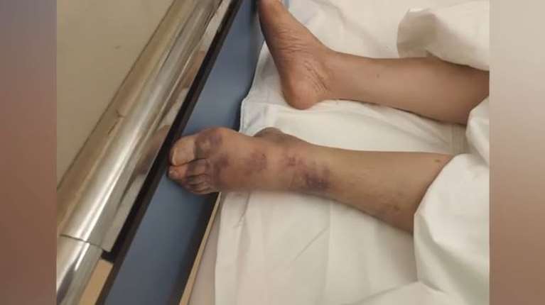 Αττική: Καταγγελία για κακοποίηση σε ιδιωτικό οίκο ευγηρίας - &quot;Μελανιασμένη, με σπασμένα πλευρά και χωρίς οξυγόνο&quot;