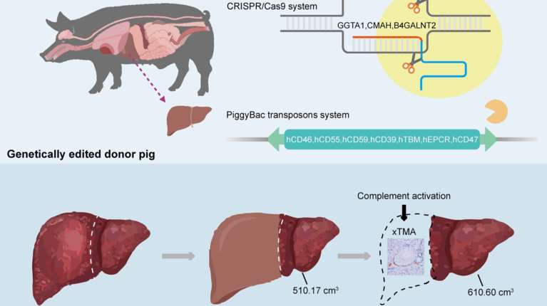 Η πρώτη στον κόσμο μεταμόσχευση ήπατος από χοίρο σε άνθρωπο - Ο ασθενής επέζησε για 171 ημέρες