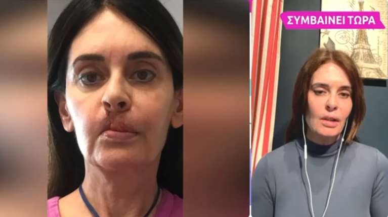 Το μαρτύριο της Κατερίνας Πλουμιδάκη από κολλαγόνο στα χείλη: &quot;Έχω κάνει 12 χειρουργεία, δεν έμεινε τίποτα από το πρόσωπό μου&quot;