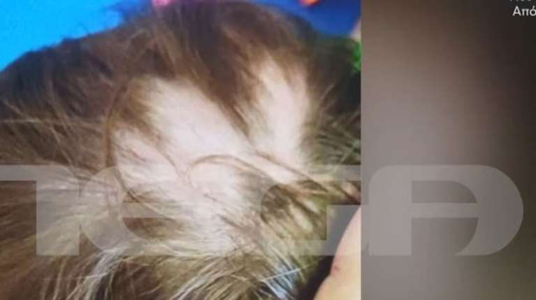 Αυλώνας: Ντοκουμέντο με το κεφαλάκι του 2χρονου μετά το περιστατικό - "Ατυχές συμβάν" λέει ο ιδιοκτήτης του βρεφονηπιακού