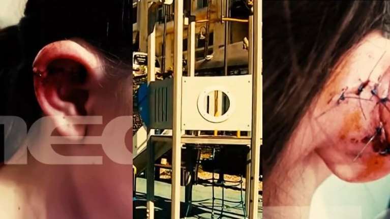 Αμφιλοχία: 9χρονο κοριτσάκι έσκισε το αυτί της σε τσουλήθρα με σχοινιά - Έκανε 20 ράμματα, χωρίς άδεια η παιδική χαρά