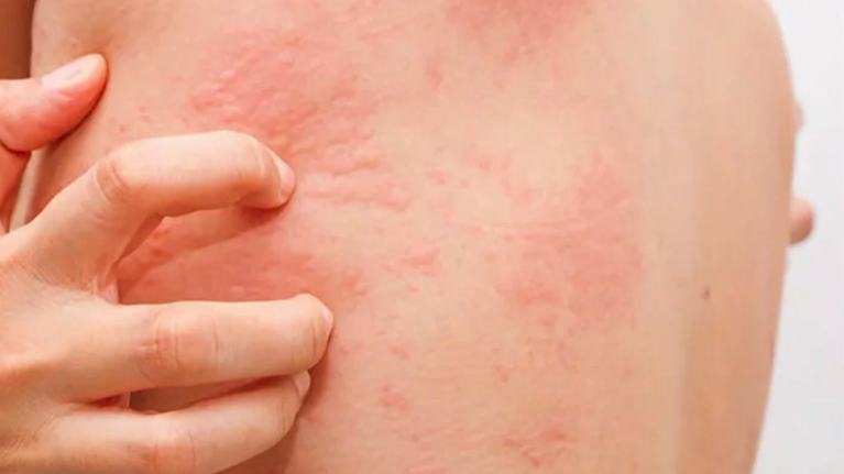 Νορβηγική ψώρα: Τα συμπτώματα και πώς μεταδίδεται - Τι πρέπει να ξέρετε