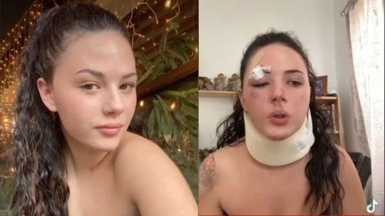 Συγκλονίζει η Μυρσίνη μετά το τροχαίο με μηχανάκι: &quot;Έπεσα κατευθείαν με το κεφάλι, ζω από θαύμα&quot;- Δεν φόραγε κράνος