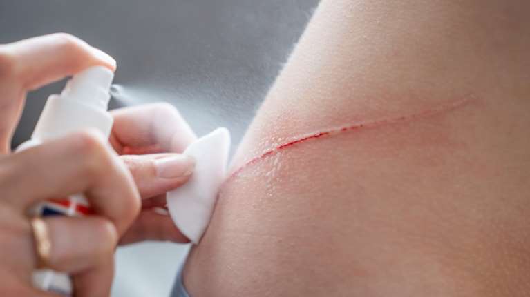 Η &quot;φυσική αντιβίωση&quot;: Η τροφή που καταπολεμά λοιμώξεις και επουλώνει τραύματα