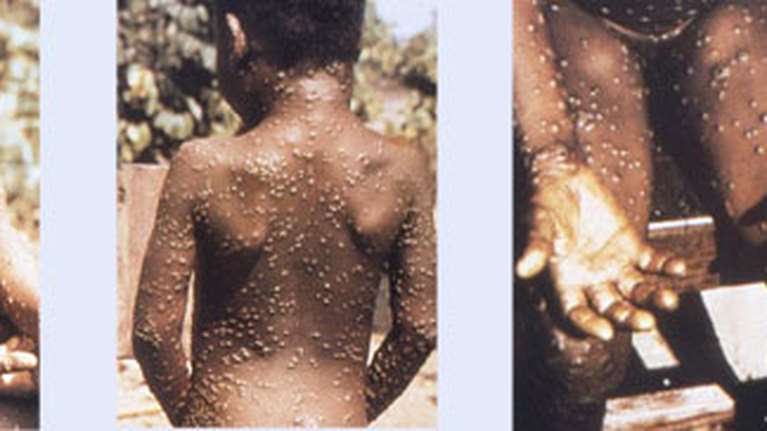 Καθηγητής Μικροβιολογίας για ευλογιά πιθήκων: Εύκολα μπορεί να γίνουν 10.000 τα κρούσματα παγκοσμίως