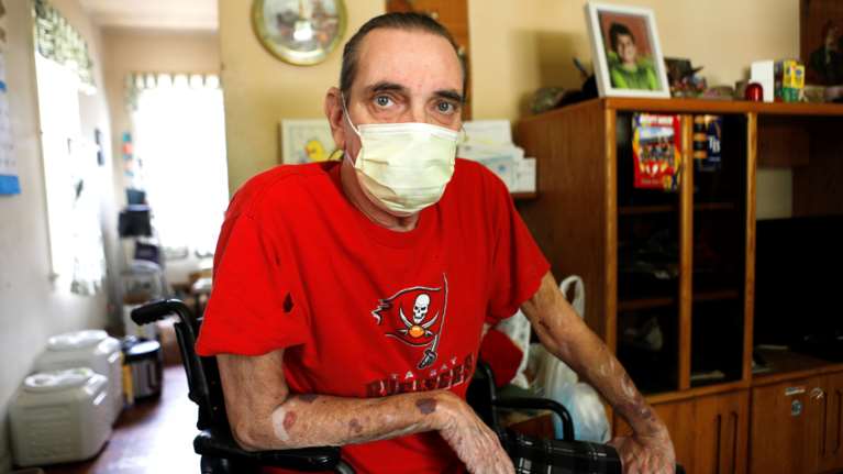 Κορονοϊός - &quot;Μακρά Covid&quot;: Με επίμονα συμπτώματα για ένα χρόνο οι μισοί ασθενείς - Τι αποκαλύπτει σημαντική έρευνα