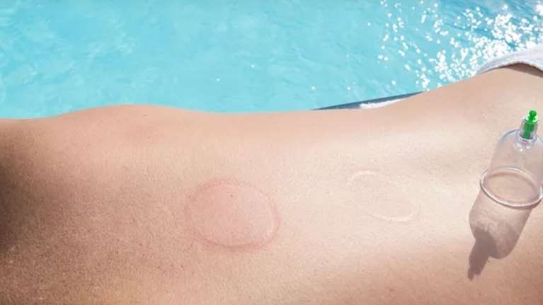 Γιατί οι αθλητές των Ολυμπιακών αγώνων κάνουν &quot;βεντούζες&quot;: Τα είδη και το αποτέλεσμα