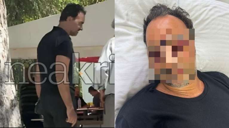 Κρήτη: Εξιτήριο για τον Ελληνοκαναδό που ξυλοκοπήθηκε άγρια- Έχει προβλήματα όρασης, ασύλληπτοι οι δράστες