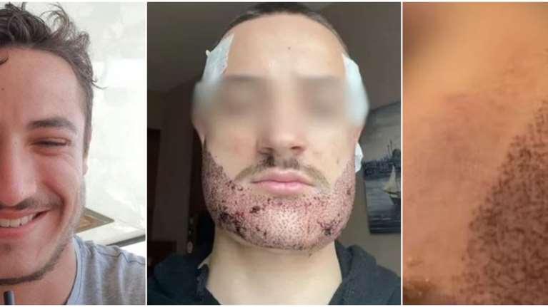 Γάλλος φοιτητής αυτοκτόνησε μετά από αποτυχημένη μεταμόσχευση γενειάδας στην Τουρκία - "Του την έκανε κτηματομεσίτης"