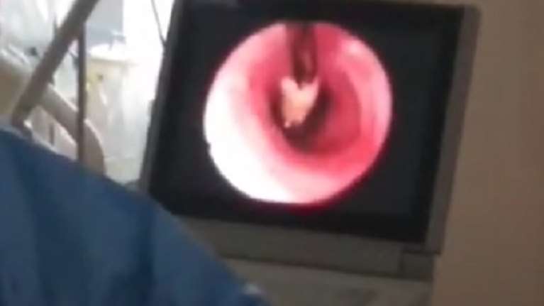 Βίντεο σοκ: Αφαίρεσαν καρύδι από πνεύμονα 10μηνου βρέφους στην Πάτρα