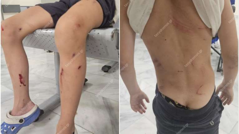 Τρόμος στον Βόλο: Τρία μεγαλόσωμα αδέσποτα σκυλιά παραλίγο να κατασπαράξουν 7χρονο - Σοκαριστική εικόνα