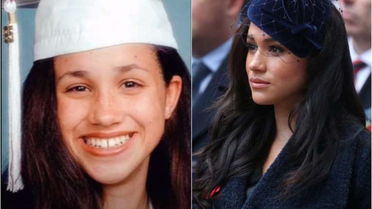 Οδοντοστοιχία, ζυγωματικά, στήθος: Όλες οι πλαστικές και αισθητικές παρεμβάσεις της Μέγκαν Μαρκλ μέχρι σήμερα [Εικόνες - Βίντεο]