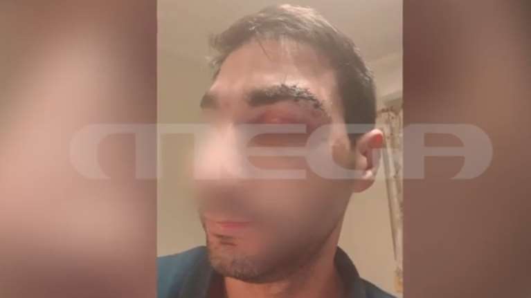 Αίγιο: Ασθενής - μποξέρ χτύπησε γιατρό - "Με βάραγε 20 λεπτά, μισή ώρα  και έλεγε δεν μ’αρέσει η μούρη σου"