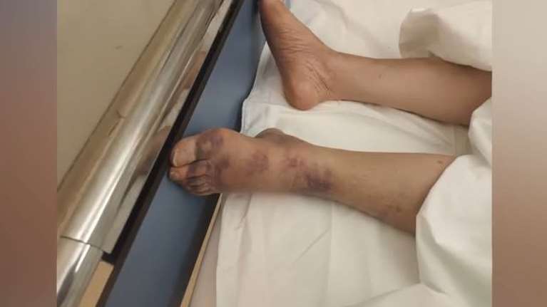 Αττική: Καταγγελία για κακοποίηση σε ιδιωτικό οίκο ευγηρίας - &quot;Μελανιασμένη, με σπασμένα πλευρά και χωρίς οξυγόνο&quot;