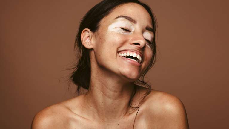 Τι είναι η λεύκη; Η θεραπεία και συμβουλές για το καλοκαίρι