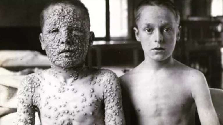 Ευλογιά: Η ασθένεια που εξαφάνισαν τα εμβόλια – Το παράδειγμα για τους αντιεμβολιαστές