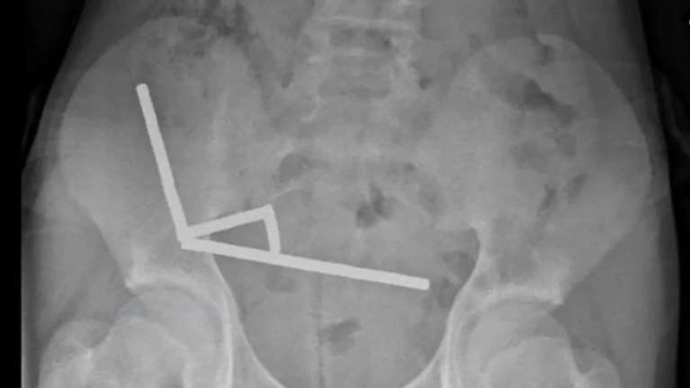 Νέα Ζηλανδία: 13χρονος κατάπιε σχεδόν 100 μαγνήτες και νέκρωσε ιστός στο έντερό του