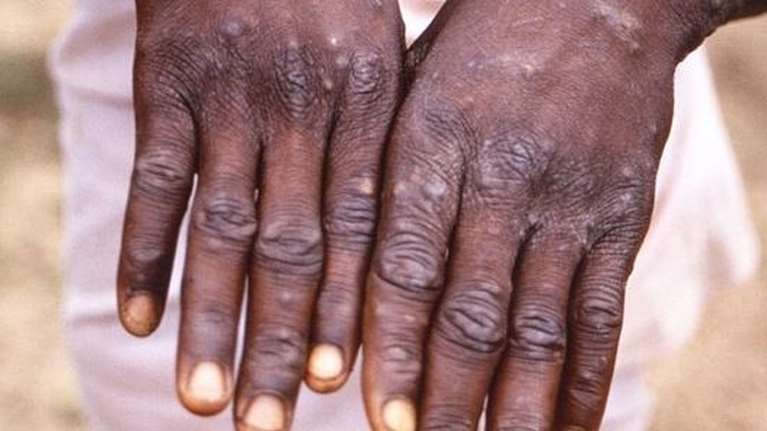 Τι γνωρίζουμε έως τώρα για την ευλογιά των πιθήκων: Πόσο διαρκεί η νόσος- Οι θεραπείες