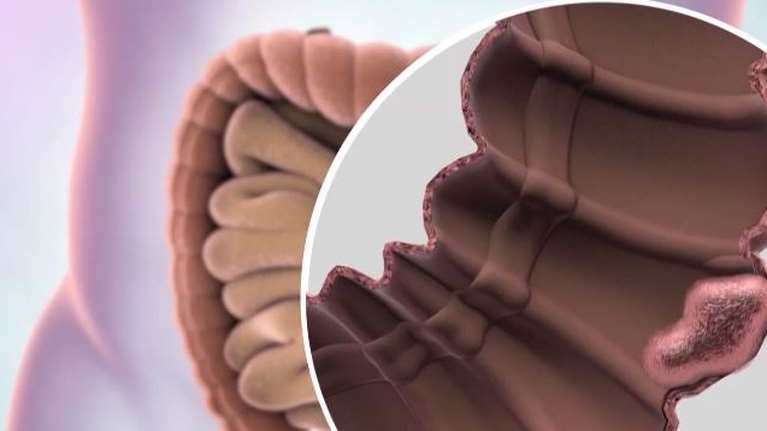 Καρκίνος του παχέος εντέρου- Τι πρέπει να ξέρουμε εάν βγει θετικό το σελφ τεστ