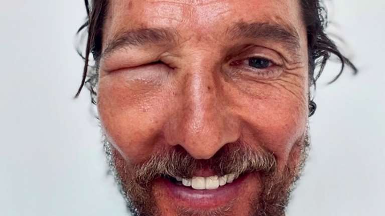 Τι να κάνεις έαν σε τσιμπήσει μέλισσα στο μάτι όπως τον Μάθιου ΜαkΚόναχι