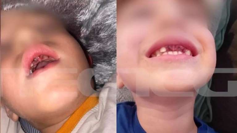Αδιανόητο: 5χρονα έσπασαν με μπουνιές τα δόντια 4χρονου με αυτισμό - &quot;Μου είπαν ότι... κουτούλησαν&quot;