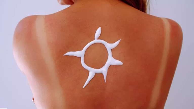 Πώς να θεραπεύσεις γρήγορα το ηλιακό έγκαυμα: Τα γιατροσόφια που δεν ισχύουν και οι σωστές οδηγίες