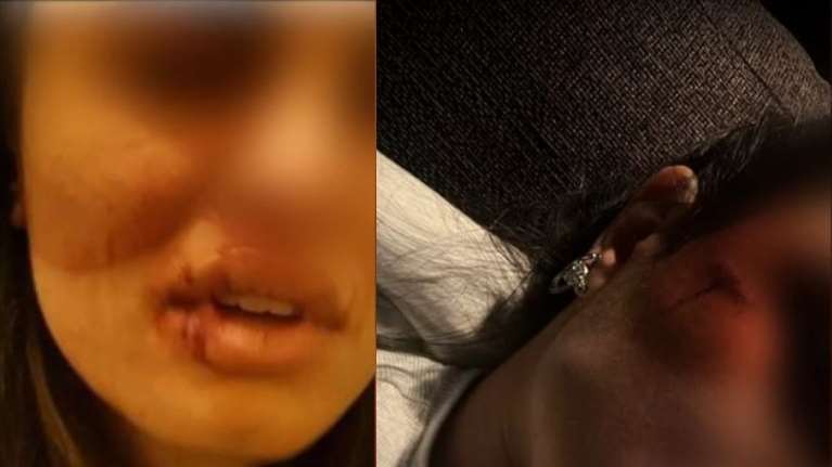 Πάτρα: Σοκάρουν οι φωτογραφίες της άγρια κακοποιημένης 23χρονης - &quot;Φοβάμαι να ζήσω&quot;, λέει το γνωστό μοντέλο