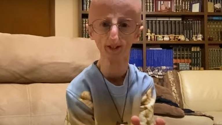 Πέθανε  ο Σάμι Μπάσο, ο άνδρας που έζησε περισσότερο από κάθε άλλο ασθενή με το σύνδρομο της προγηρίας