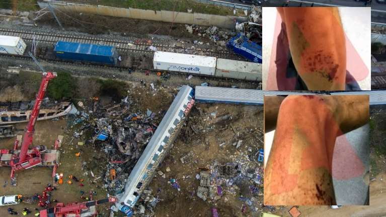 Τέμπη: Χημικά εγκαύματα λένε ότι υπέστησαν δύο πυροσβέστες- Άθικτες οι στολές, δεν αισθάνθηκαν κάψιμο