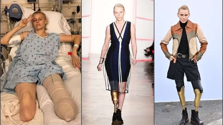 Μοντέλο έπαθε Σύνδρομο Τοξικού Σοκ από ταμπόν - Της ακρωτηρίασαν και τα δύο πόδια - &quot;Κανείς δεν είναι αλώβητος&quot;