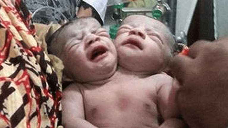 Μωρό γεννήθηκε με δύο κεφάλια στο Μπαγκλαντές