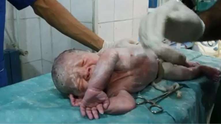 Γιατροί στο Χαλέπι της Συρίας επανέφεραν στη ζωή νεογέννητο αγοράκι