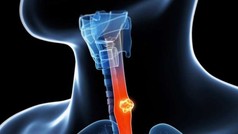 Τεστ &quot;βλέπει&quot; μορφή καρκίνου 10 χρόνια πριν εκδηλωθεί