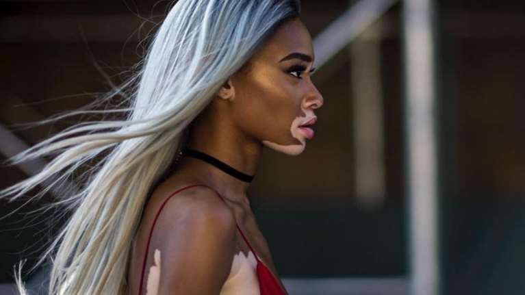 Μοντέλο με λεύκη ποζάρει με τα εσώρουχα και μας κάνει μάθημα αυτοπεποίθησης