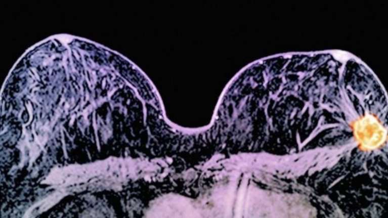 Συνδυασμός φαρμάκων εξαφάνισε καρκινικούς όγκους σε 11 μέρες