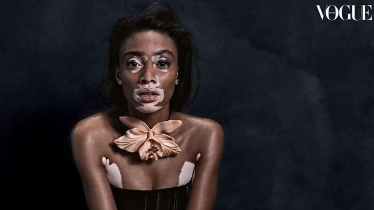 Γουίνι Χάρλοου: Δείχνει με υπερηφάνεια τις «ατέλειές» της και αποθεώνεται