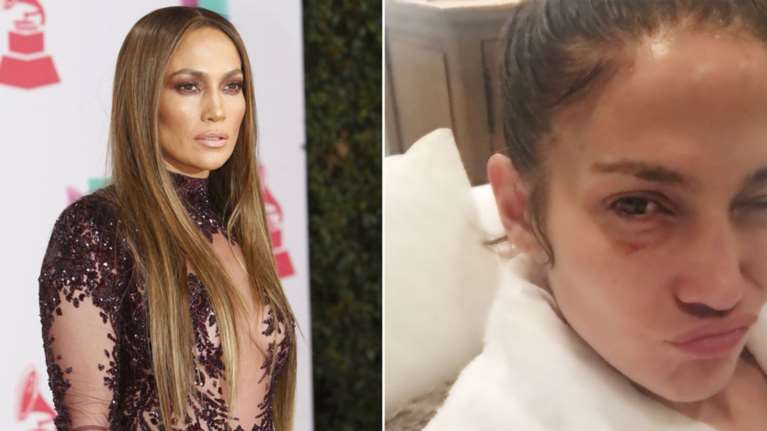 Μελανιασμένη στο instagram η Τζένιφερ Λόπεζ. Τι συνέβη