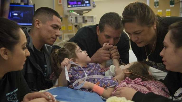 Οι γιατροί στην Καλιφόρνια πέτυχαν τον διαχωρισμό σιαμαίων