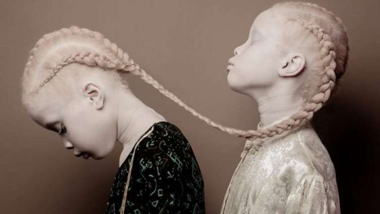 Δίδυμα κορίτσια με αλμπινισμό κατακτούν τον κόσμο της μόδας