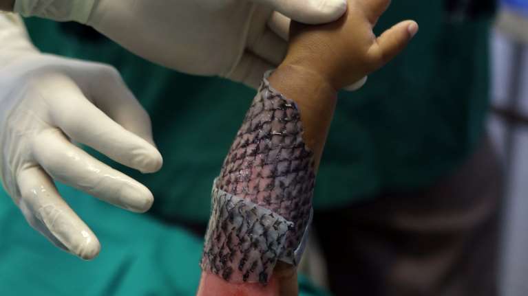 Με δέρμα ψαριού θεραπεύουν βαθιά εγκαύματα στη Βραζιλία