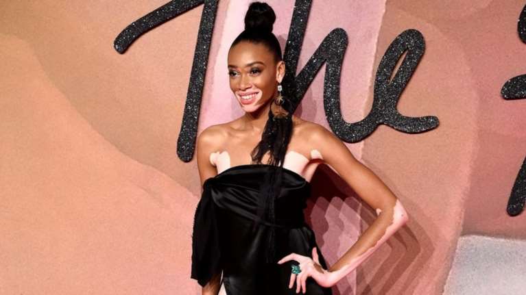 22χρονη καλλονή με λεύκη μας δείχνει το υπέροχα «σημαδεμένο» κορμί της