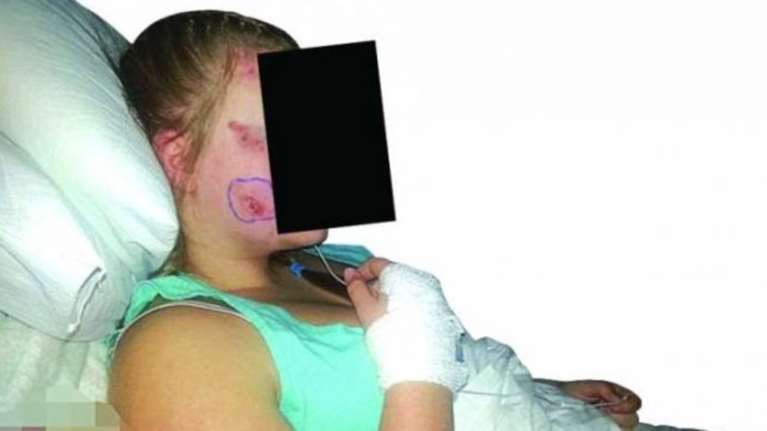 Κινδυνεύει να μείνει σημαδεμένη σε όλη της τη ζωή από μέδουσα