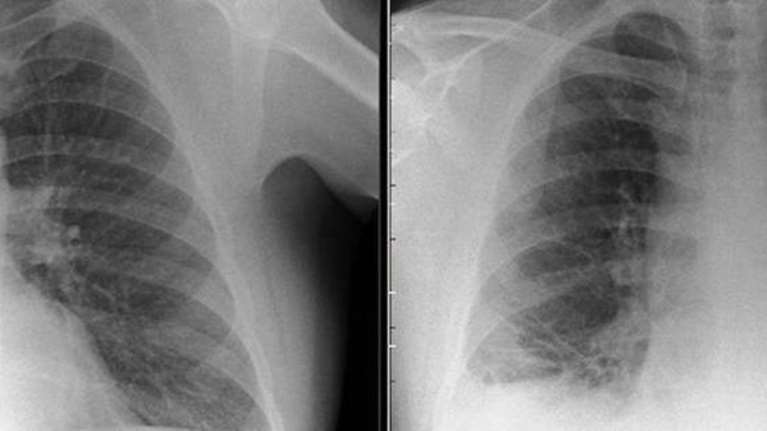 Οι γιατροί νόμιζαν ότι είχε καρκίνο, αλλά ο όγκος ήταν ένα Playmobil !