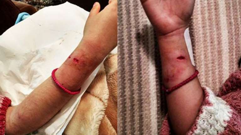 Επίθεση από σκυλιά σε 7χρονο κοριτσάκι στη Λέσβο