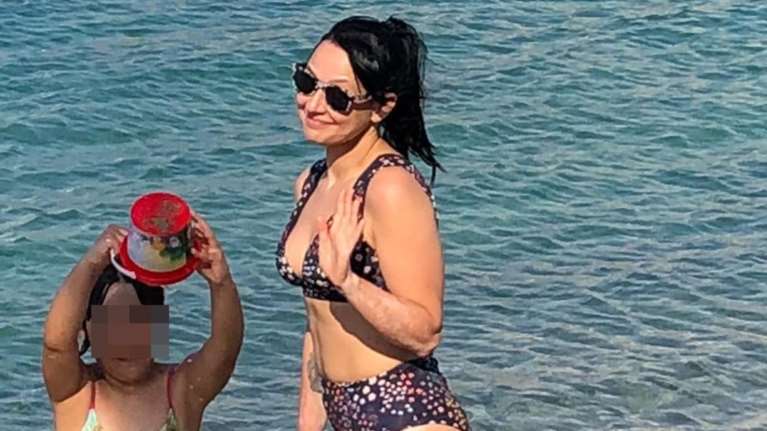 Αθηναΐς Νέγκα: Φορά μαγιό και δείχνει τα σημάδια της λεύκης στο κορμί της