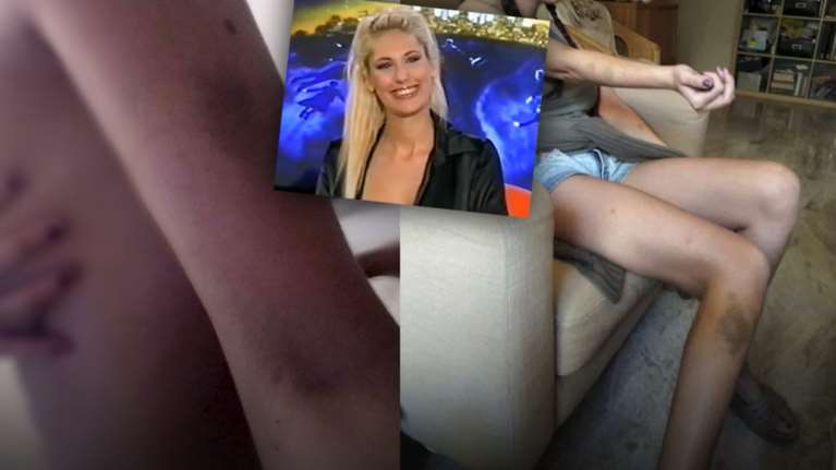 Το κορίτσι του Θέμου καταγγέλει άγριο ξυλοδαρμό από τον πρώην σύντροφό της