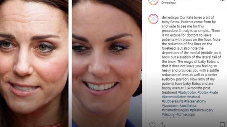 Ανω κάτω το Παλάτι: Επίσημη δήλωση για το baby botox της Κέιτ